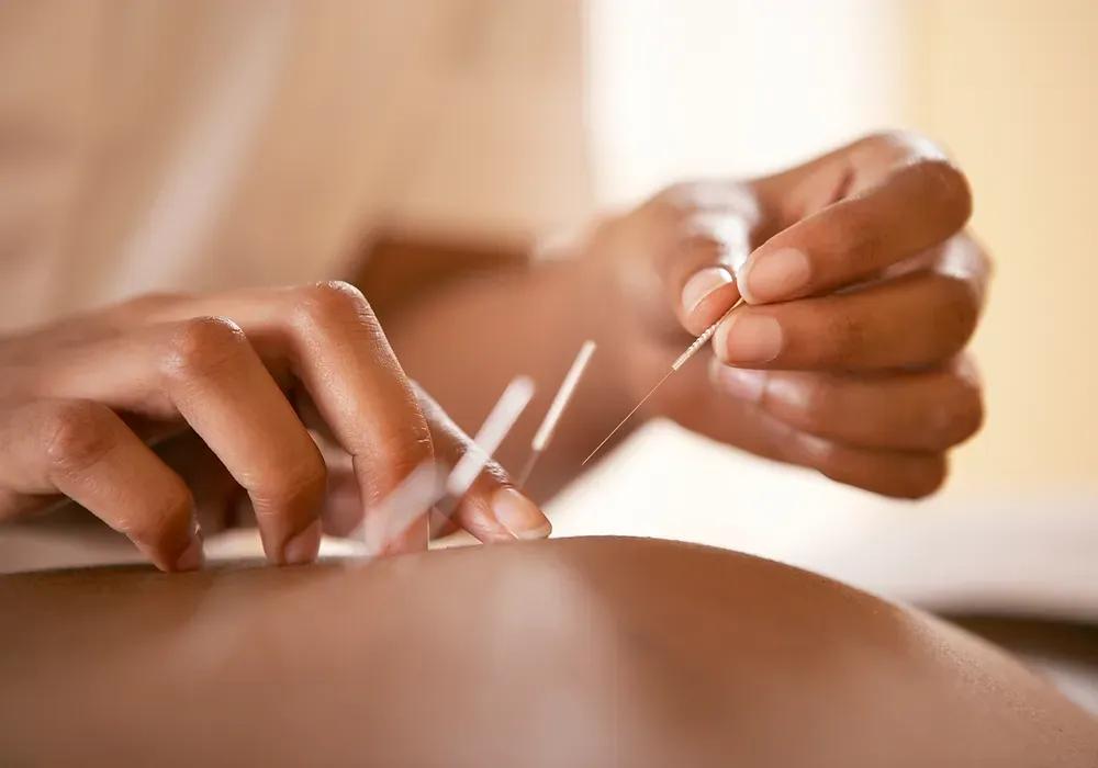 Dry Needling — MBS Remedial Massage Sydney